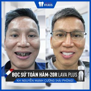 Hình ảnh bọc răng sứ của KH Nguyễn Mạnh Cường – Ca 103
