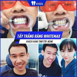 Hình ảnh tẩy trắng răng Whitemax của KH Thư – Ca 105