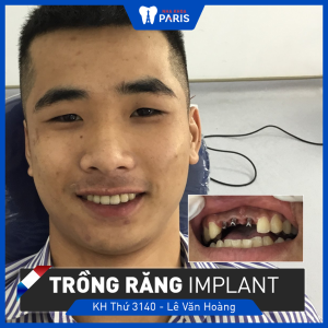 Hình ảnh trồng răng implant của KH Lê Văn Hoàng – Ca 107
