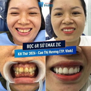 Hình ảnh bọc răng sứ của KH Cao Thị Hương – Ca 108