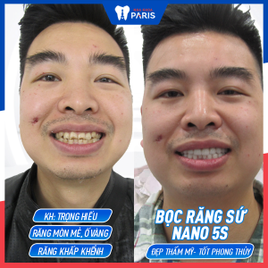 Hình ảnh bọc răng sứ nano 5s của KH Trọng Hiếu – Ca 11