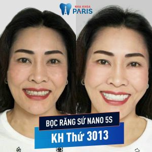 Hình ảnh bọc răng sứ nano 5s của KH Trần Thị Huệ - Ca 110
