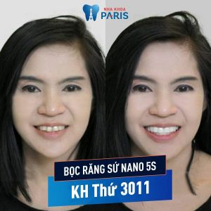 Hình ảnh bọc răng sứ nano 5S của KH Anna Trần – Ca 111