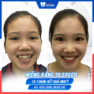 Hình ảnh niềng răng 3D Speed của KH Hoài Dung – Ca 12