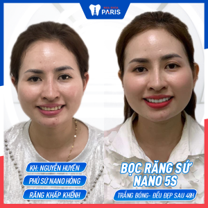 Hình ảnh bọc răng sứ nano 5S của KH Nguyễn Huyền – Ca 13