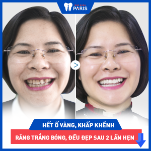 Hình ảnh bọc răng sứ của KH Hồng Ly – Ca 15