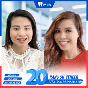 Hình ảnh dán sứ Veneer của chị Trang – Ca 17