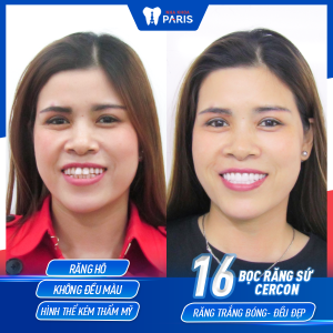 Hình ảnh bọc răng sứ cercon của KH Phạm Thị Hiên – Ca 18