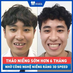 Hình ảnh niềng răng 3D Speed của một nam thanh niên – Ca 20