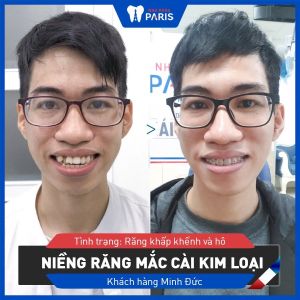 Hình ảnh niềng răng mắc cài kim loại của KH Minh Đức – Ca 21