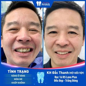 Hình ảnh bọc 16 răng sứ Lava Plus của KH Đắc Thanh – Ca 22