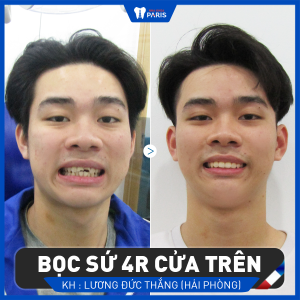 Hình ảnh bọc sứ 4 răng cửa trên của KH Lương Đức Thắng – Ca 23