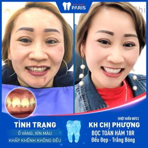 Hình ảnh bọc răng sứ của KH chị Phượng – Ca 24