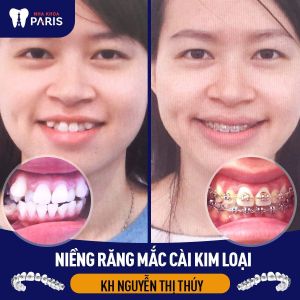 Hình ảnh niềng răng mắc cài kim loại của KH Nguyễn Thị Thúy – Ca 26