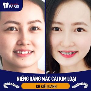 Hình ảnh niềng răng mắc cài kim loại của KH Kiều Oanh – Ca 27