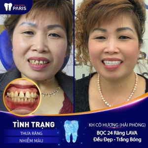 Hình ảnh bọc răng sứ của KH cô Hương – Ca 28