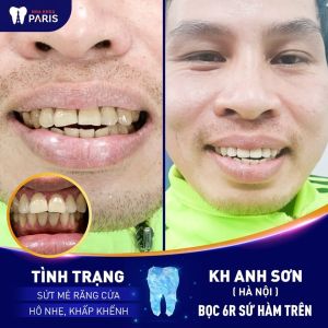 Hình ảnh bọc răng sứ của KH anh Sơn – Ca 29