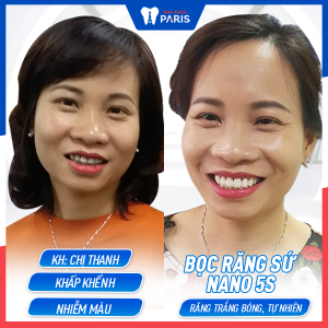 Hình ảnh bọc răng sứ nano 5s của KH Nguyễn Thị Thanh – Ca 03