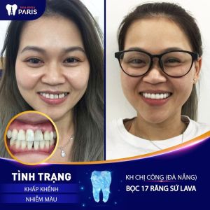 Hình ảnh bọc răng sứ Lava cho KH chị Công – Ca 30
