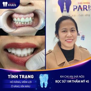 Hình ảnh bọc răng sứ của KH chị An – Ca 31