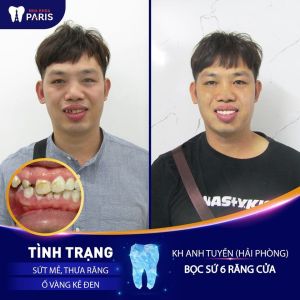 Hình ảnh bọc răng sứ của KH anh Tuyền – Ca 32