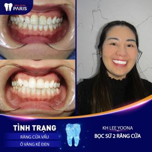 Hình ảnh bọc sứ 2 răng cửa của KH Lee Yoona – Ca 33