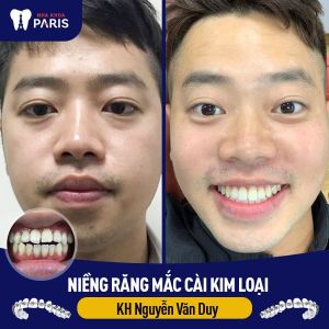Hình ảnh niềng răng mắc cài kim loại của KH Nguyễn Văn Duy – Ca 34