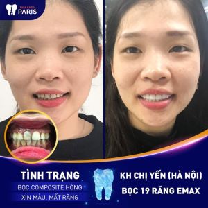 Hình ảnh bọc răng sứ Emax của KH chị Yến – Ca 35