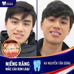 Hình ảnh niềng răng mắc cài kim loại của KH Nguyễn Tấn Dũng – Ca 39