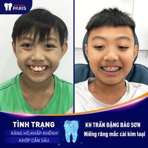 Hình ảnh niềng răng mắc cài kim loại của KH Trần Đặng Bảo Sơn – Ca 40