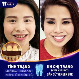 Hình ảnh dán sứ Veneer của KH chị Trang – Ca 41