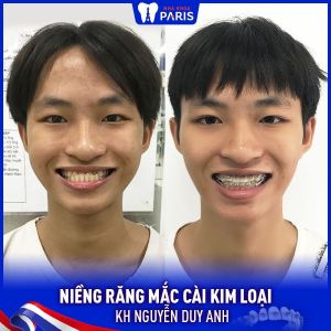 Hình ảnh niềng răng mắc cài kim loại của KH Nguyễn Duy Anh – Ca 42