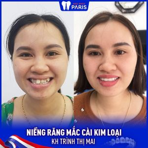Hình ảnh niềng răng thành công của KH Trình Thị Mai – Ca 43