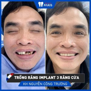 Hình ảnh trồng răng implant 3 răng cửa của KH Nguyễn Công Trường – Ca 44