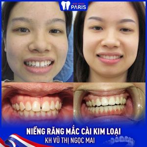 Hình ảnh niềng răng thành công của KH Vũ Thị Ngọc Mai – Ca 49