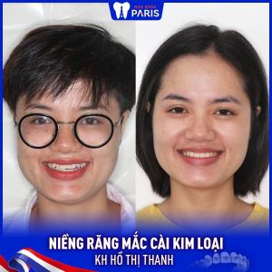 Hình ảnh niềng răng thành công của KH Hồ Thị Thanh – Ca 50