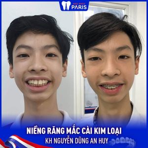 Hình ảnh niềng răng mắc cài kim loại của KH Nguyễn Dũng An Huy – Ca 51
