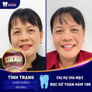Hình ảnh bọc răng sứ của KH chị Ký - Ca 52