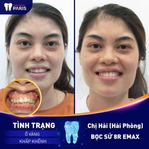 Hình ảnh bọc 8 răng sứ Emax của KH chị Hải – Ca 54