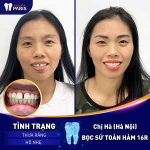 Hình ảnh bọc răng sứ toàn hàm của chị Hà – Ca 55