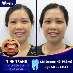 Hình ảnh bọc răng sứ toàn hàm của chị Dương – Ca 56