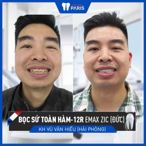 Hình ảnh bọc răng sứ của KH Vũ Văn Hiếu – Ca 57