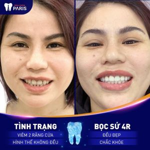 Hình ảnh bọc răng sứ của chị Hương – Ca 58
