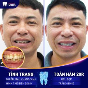 Hình ảnh bọc răng sứ toàn hàm của 1 nam khách hàng – Ca 59