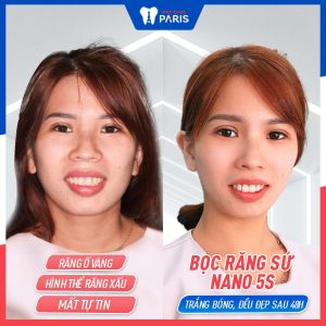 Hình ảnh bọc răng sứ nano 5s của KH Linh Giang – Ca 06