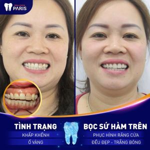 Hình ảnh bọc răng sứ hàm trên của chị Hằng – Ca 60