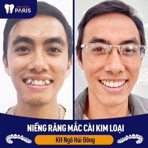 Hình ảnh niềng răng thành công của KH Ngô Hải Đông – Ca 61