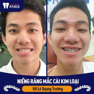 Hình ảnh niềng răng mắc cài kim loại của KH Lê Quang Trường – Ca 62