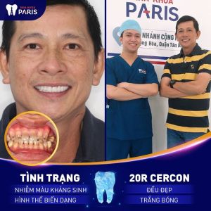 Hình ảnh bọc răng sứ Cercon của 1 nam KH trung niên – Ca 64