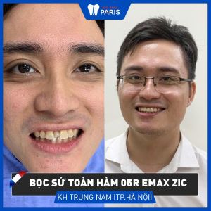 Hình ảnh bọc 5 răng sứ Emax của KH Trung Nam – Ca 68
